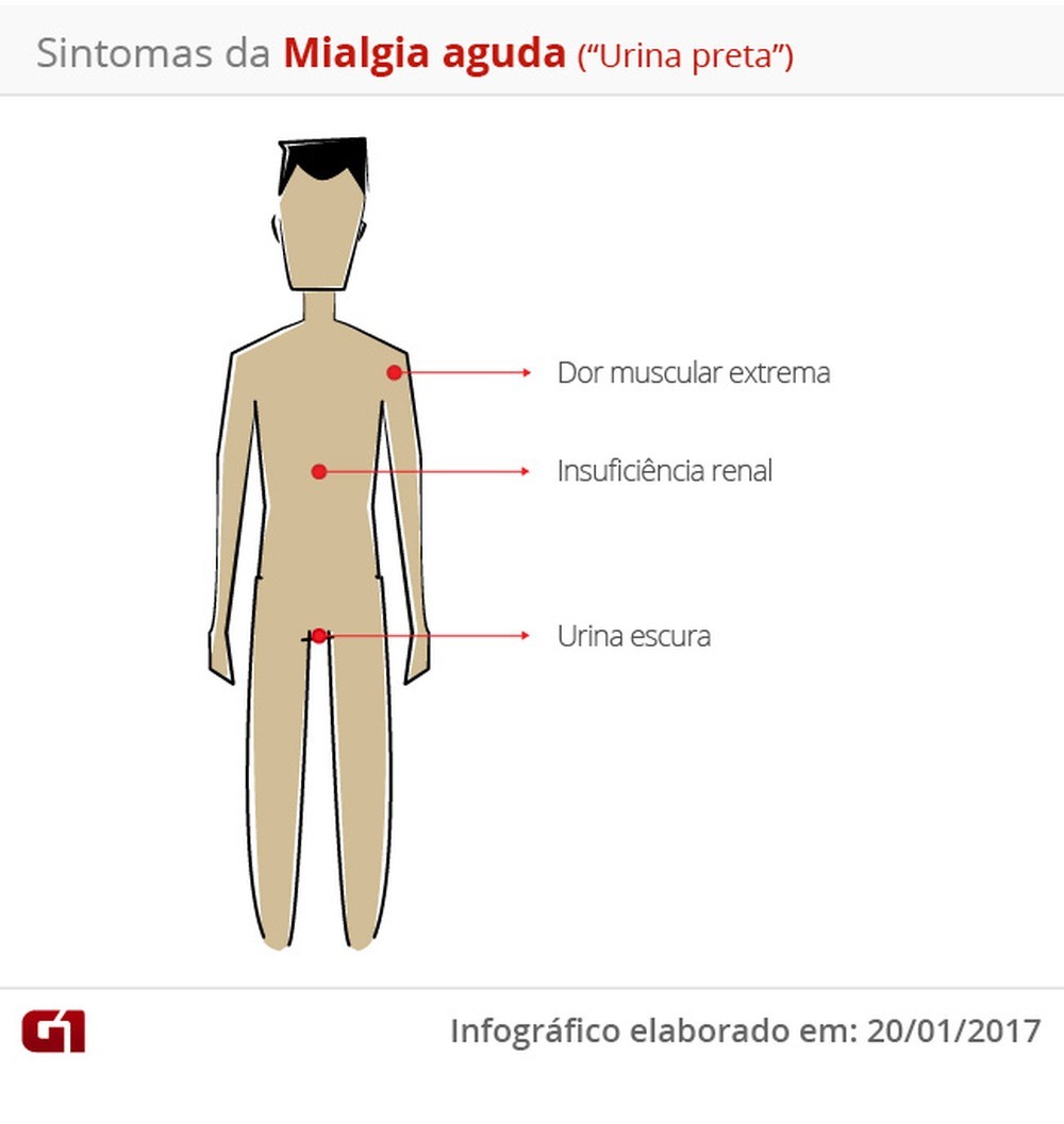 Leia mais sobre o artigo Dois casos suspeitos da doença que deixa a urina preta são investigados em Pernambuco
