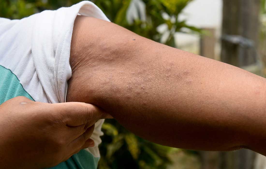 Leia mais sobre o artigo Sociedade Brasileira de Dermatologia investiga surto de lesão misteriosa na pele em Pernambuco