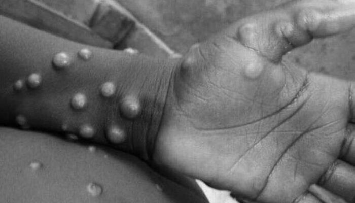 Leia mais sobre o artigo Primeiras vacinas contra varíola dos macacos devem chegar em setembro